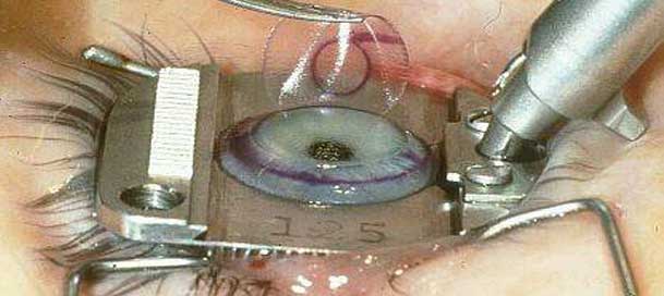 Lasik Surgery & Retinal Detachment