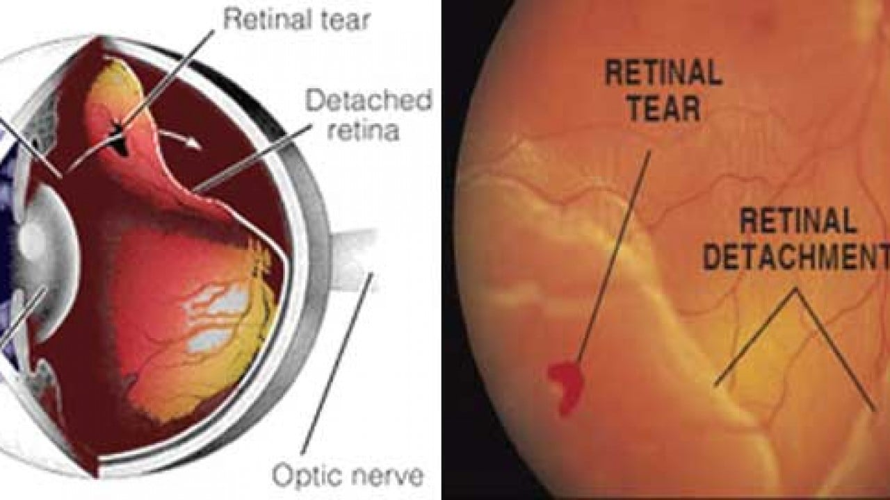 myopia retina tears)