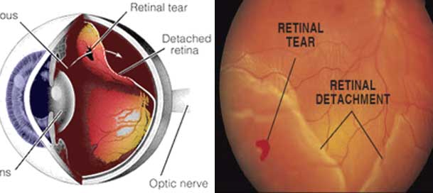 myopia retinal detachment)