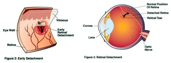retinal_detachment