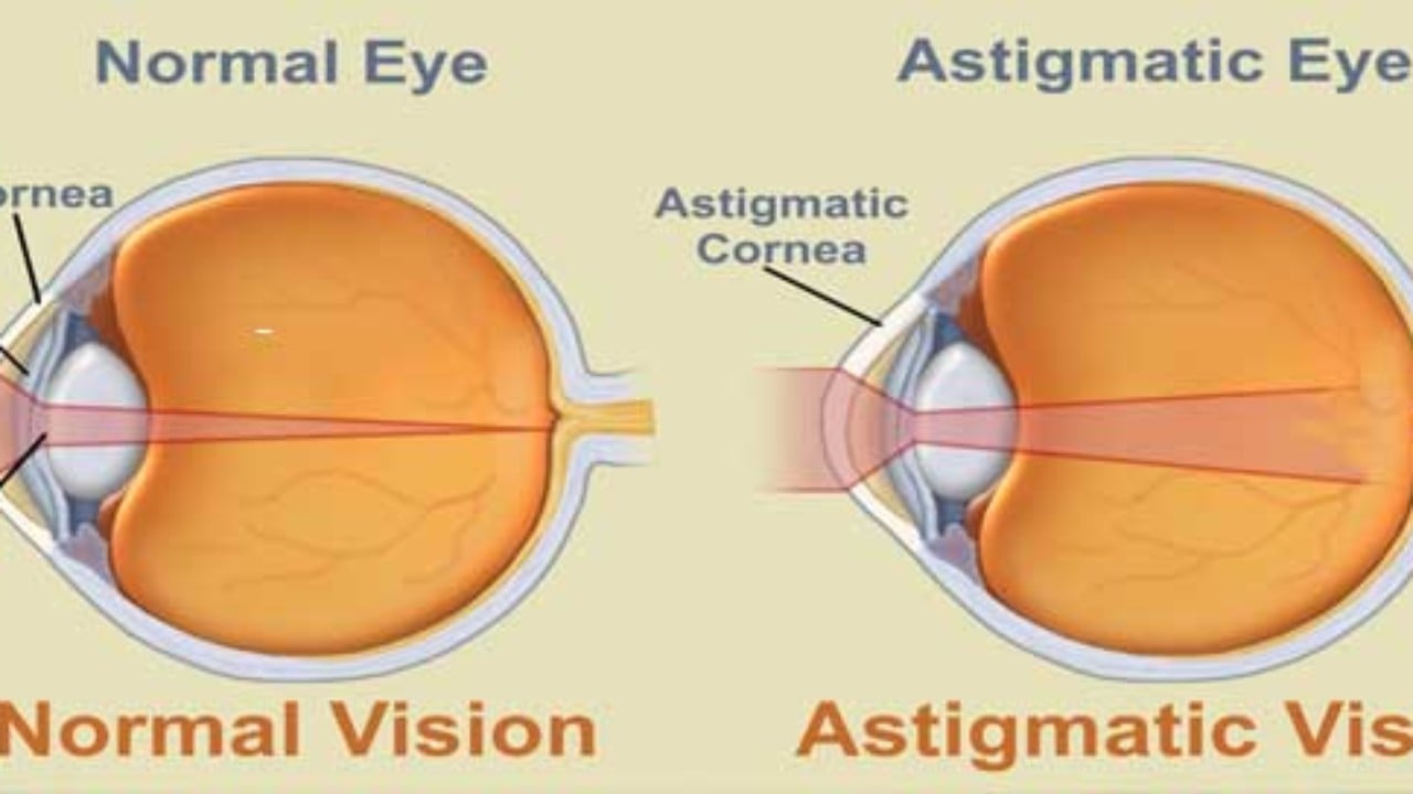 astigmatism cu miopie)