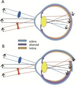 lens-induced-axial-change