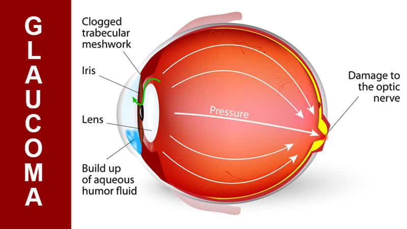 agyrázkódás romlott a látás nagyon gyenge látás szülés