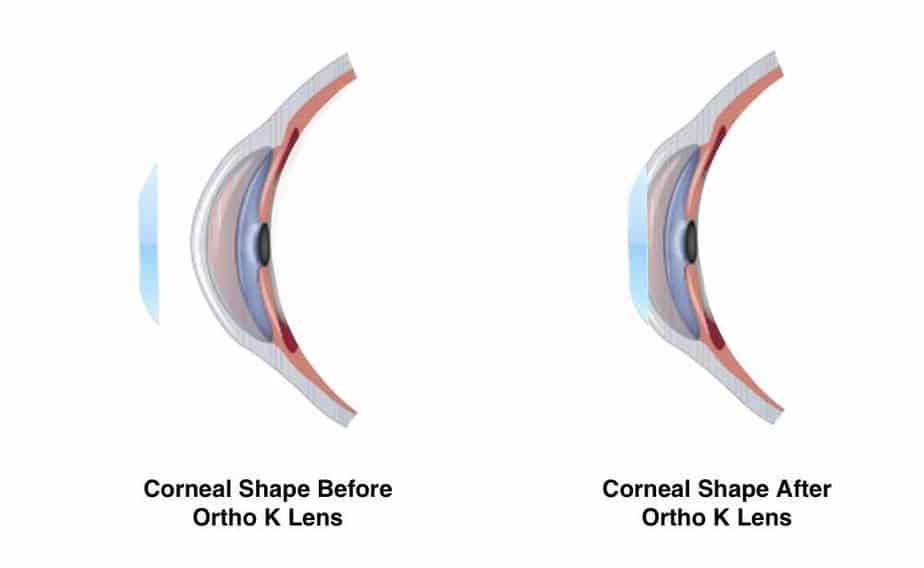 Ortho-K side effects (besides lens reshaping)