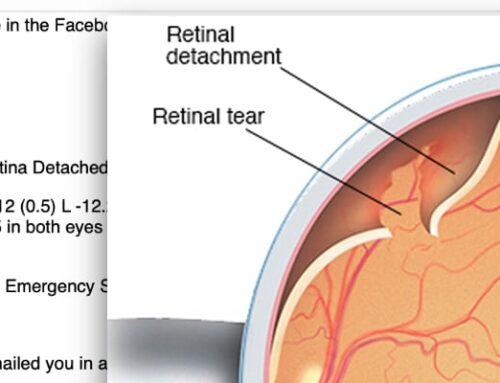 -12 Diopters, Detached Retina