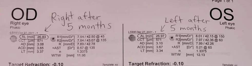 axial length after