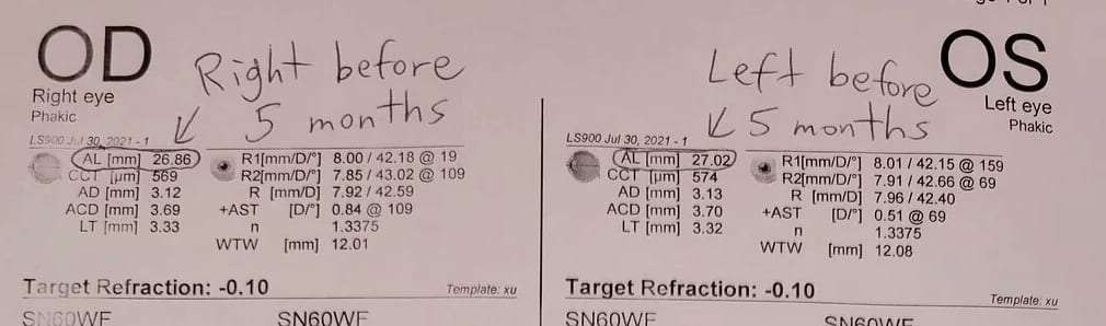 axial length measurement before